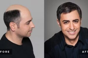 NAE Implantes Capilares No Quir&uacute;rgicos